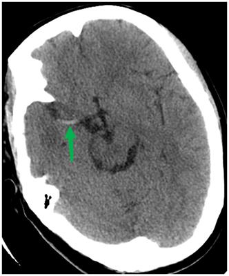 Functional and technical outcomes in acute ischemic stroke patients with hyperdense middle cerebral artery sign treated with endovascular thrombectomy